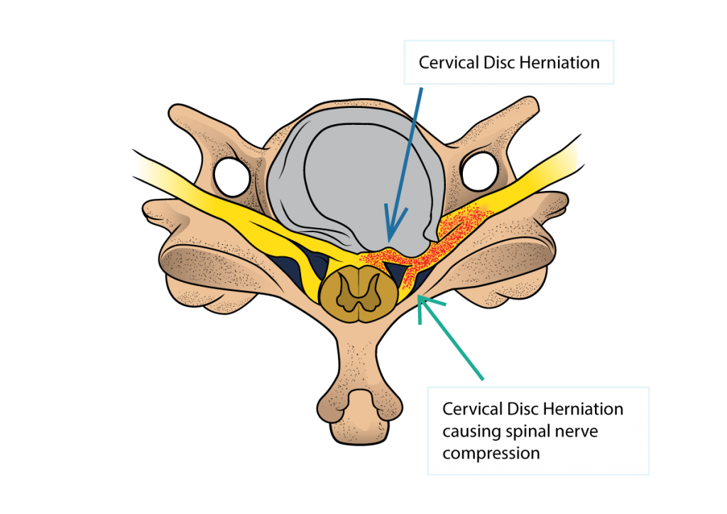 Cervical Disc Herniation and Cervical Radiculopathy