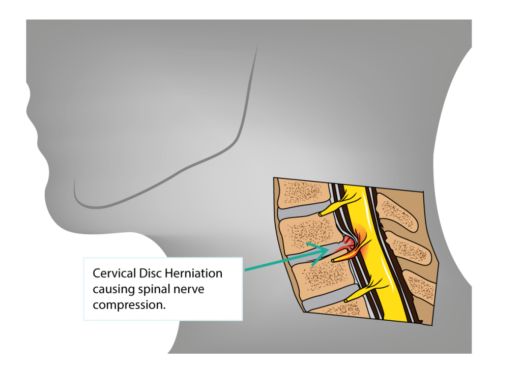Cervical Disc Herniation and Cervical Radiculopathy