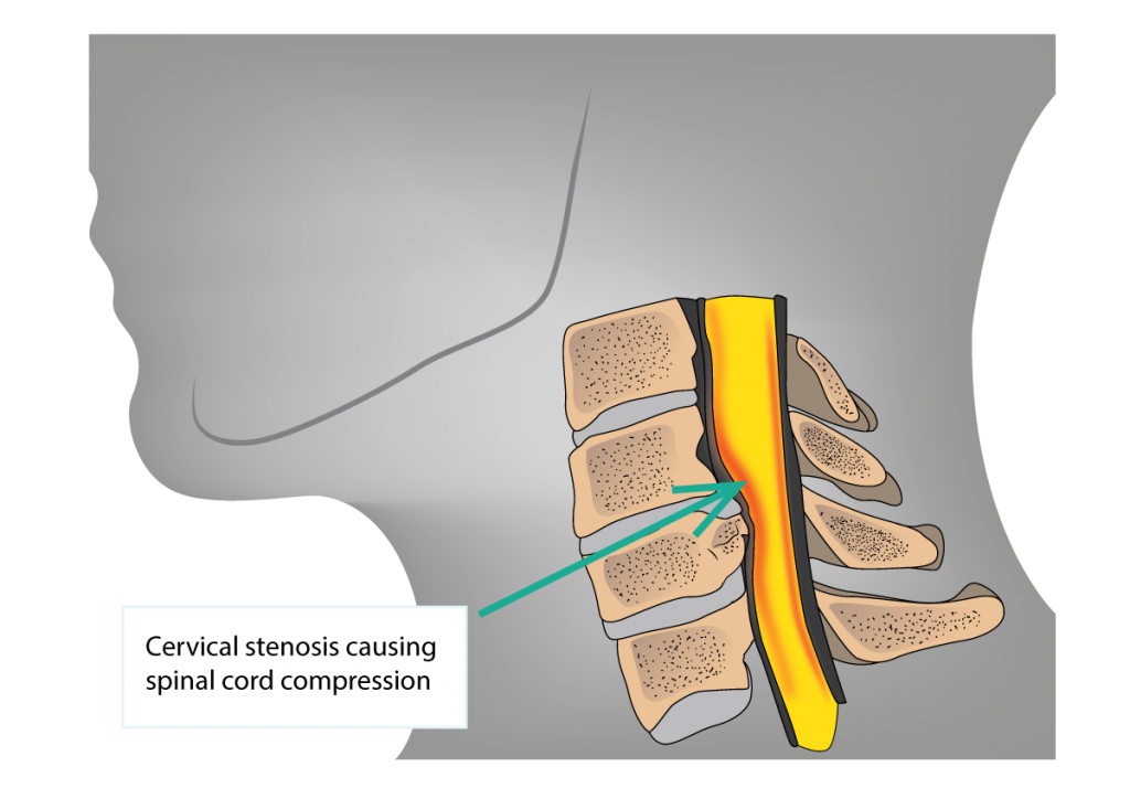 Cervical Stenosis and Cervical Myelopathy