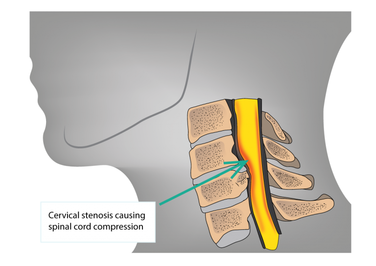 Cervical Stenosis And Cervical Myelopathy Dr Yu Chao Lee