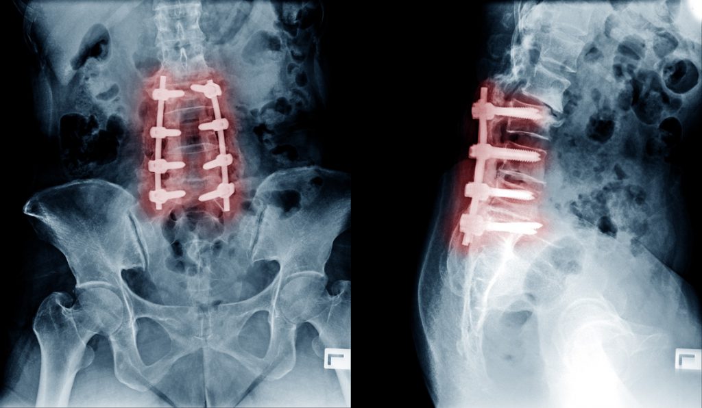 Complex Spinal Conditions Dr Yu Chao Lee