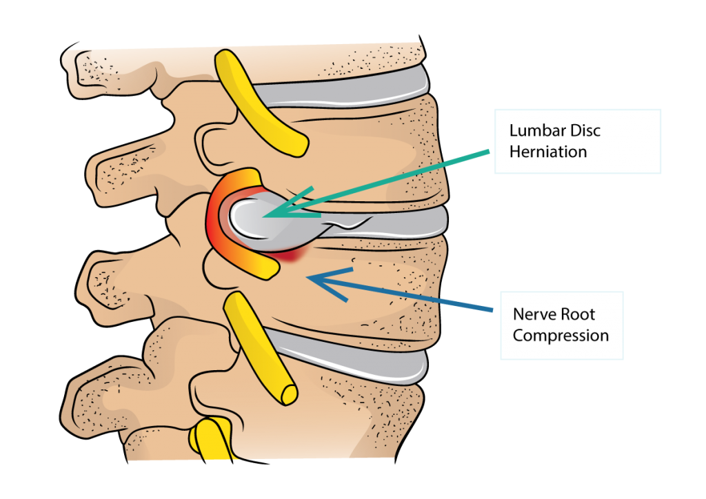 Lumbar Disc Herniation and Sciatica