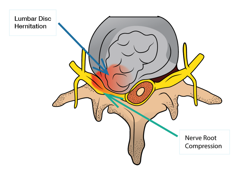 What is Lumbar Disc Herniation/Sciatica & How to Manage It? - Upswing Health