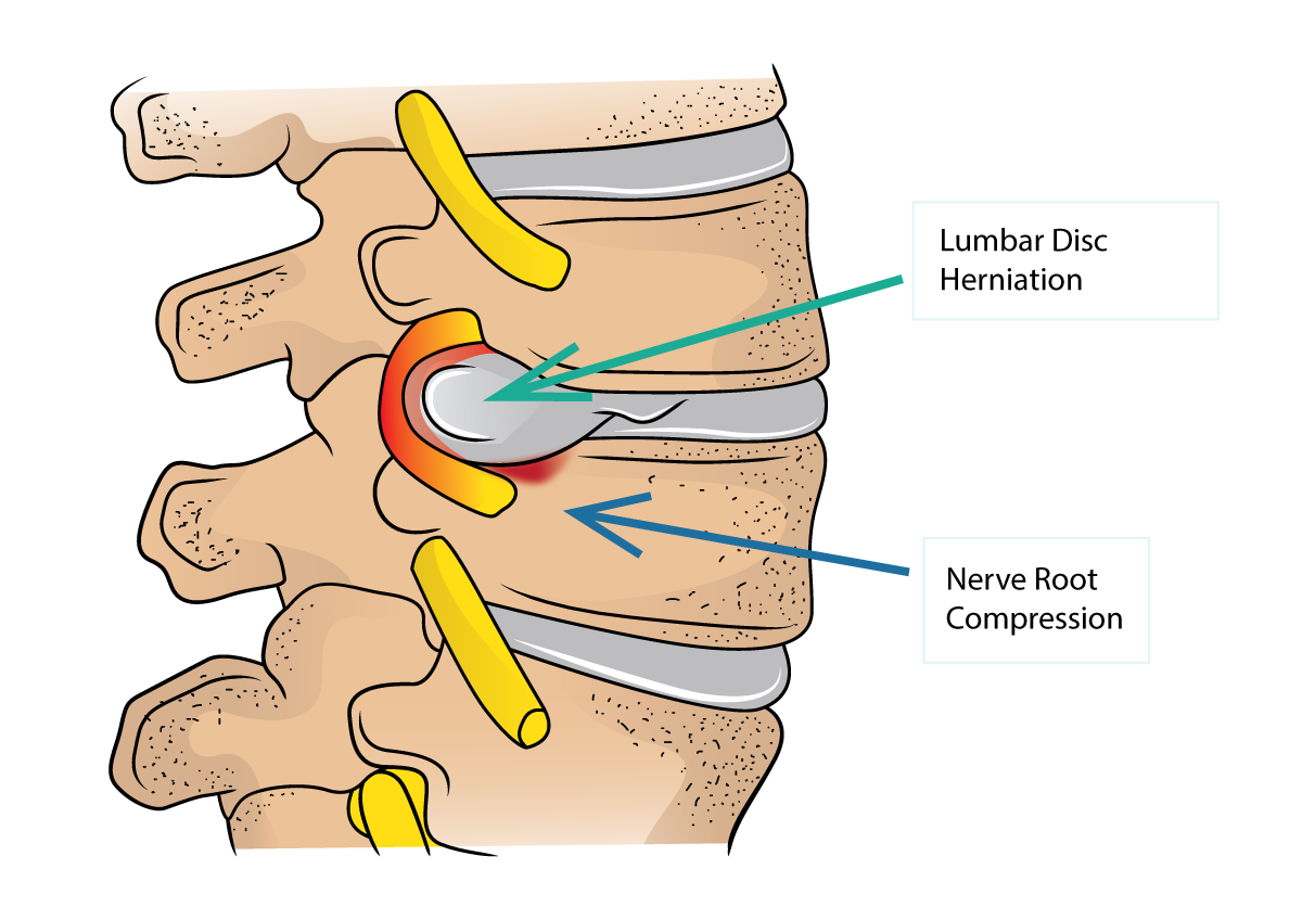 Lumbar Disc Herniation And Sciatica Dr Yu Chao Lee