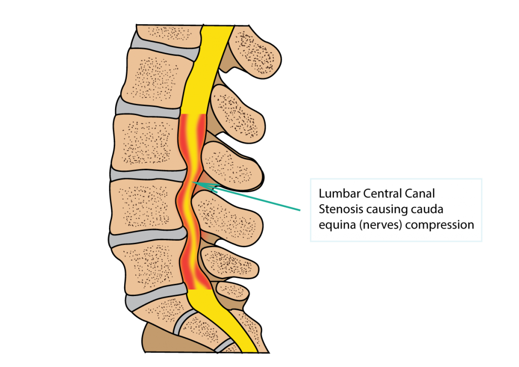 Spinal stenosis Information