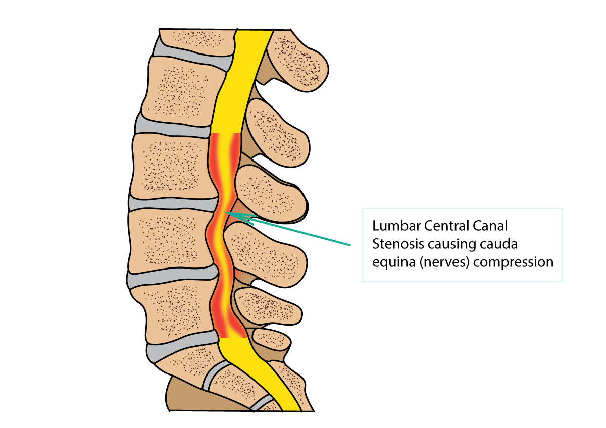 Spinal Stenosis Images Lumbar Spine