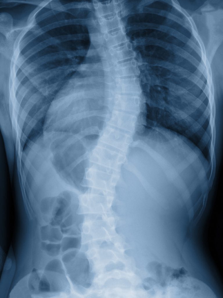 Scoliosis X ray