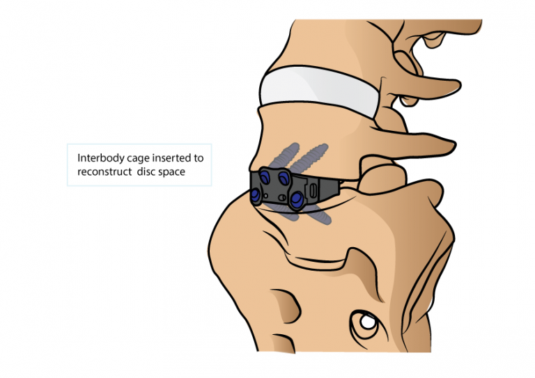 Minimal Invasive Anterior Lumbar Interbody Fusion Alif Dr Yu Chao Lee