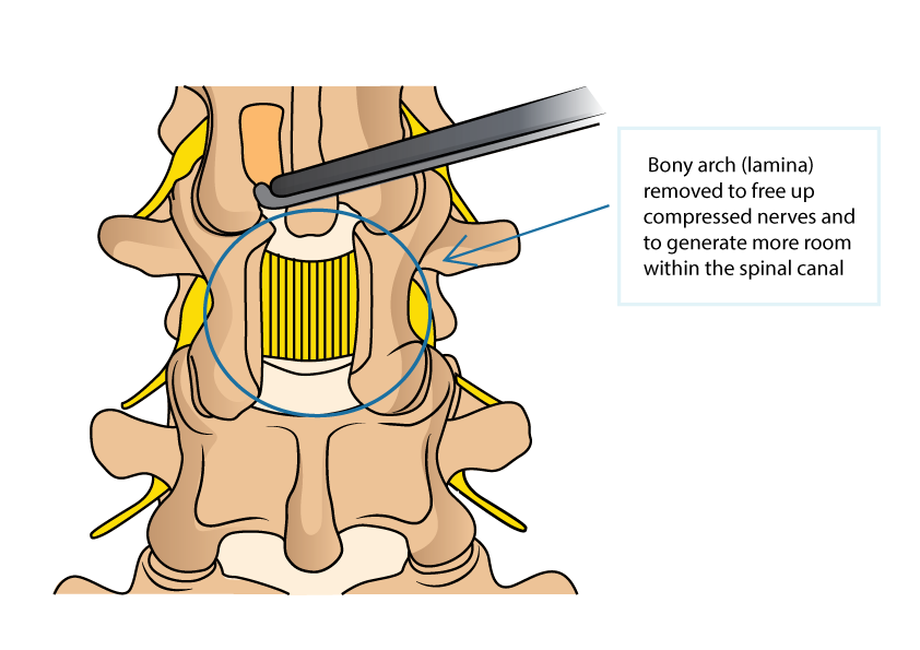 Minimally Invasive Spinal Decompression