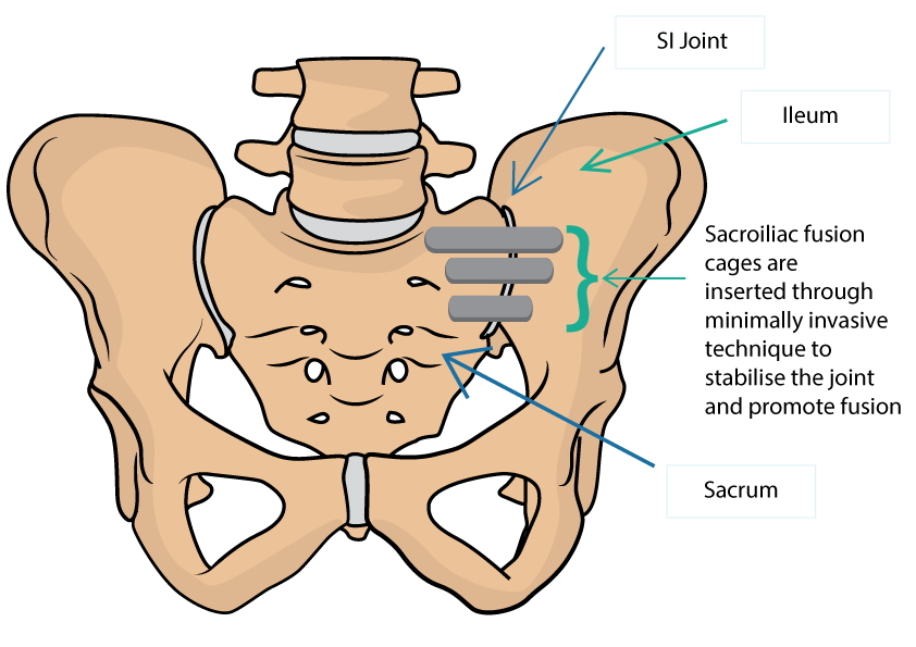 Minimally Invasive Sacroiliac Joint Fusion Dr Yu Chao Lee