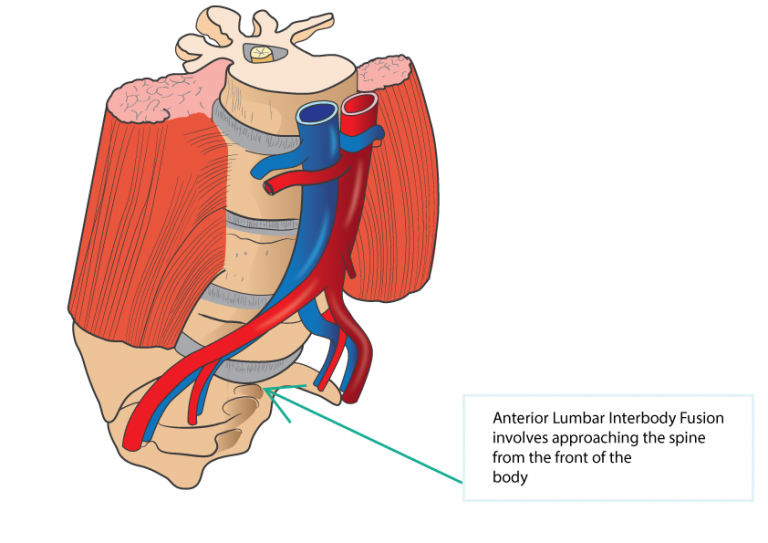 Minimal Invasive Anterior Lumbar Interbody Fusion (ALIF) | Dr Yu Chao Lee