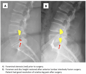 Why have I been recommended spinal fusion (lumbar fusion)? | Dr Yu Chao Lee